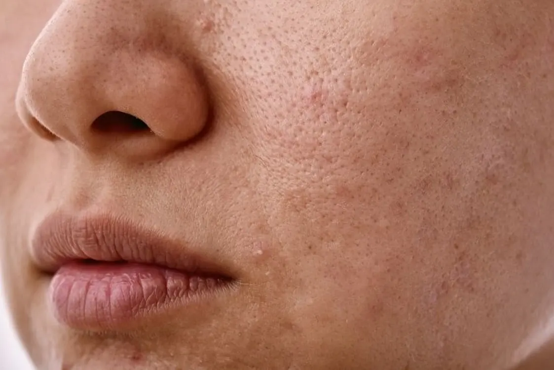 Manchas pigmentadas tratadas con peeling Hikari Cleopatra en Alef Med Valencia