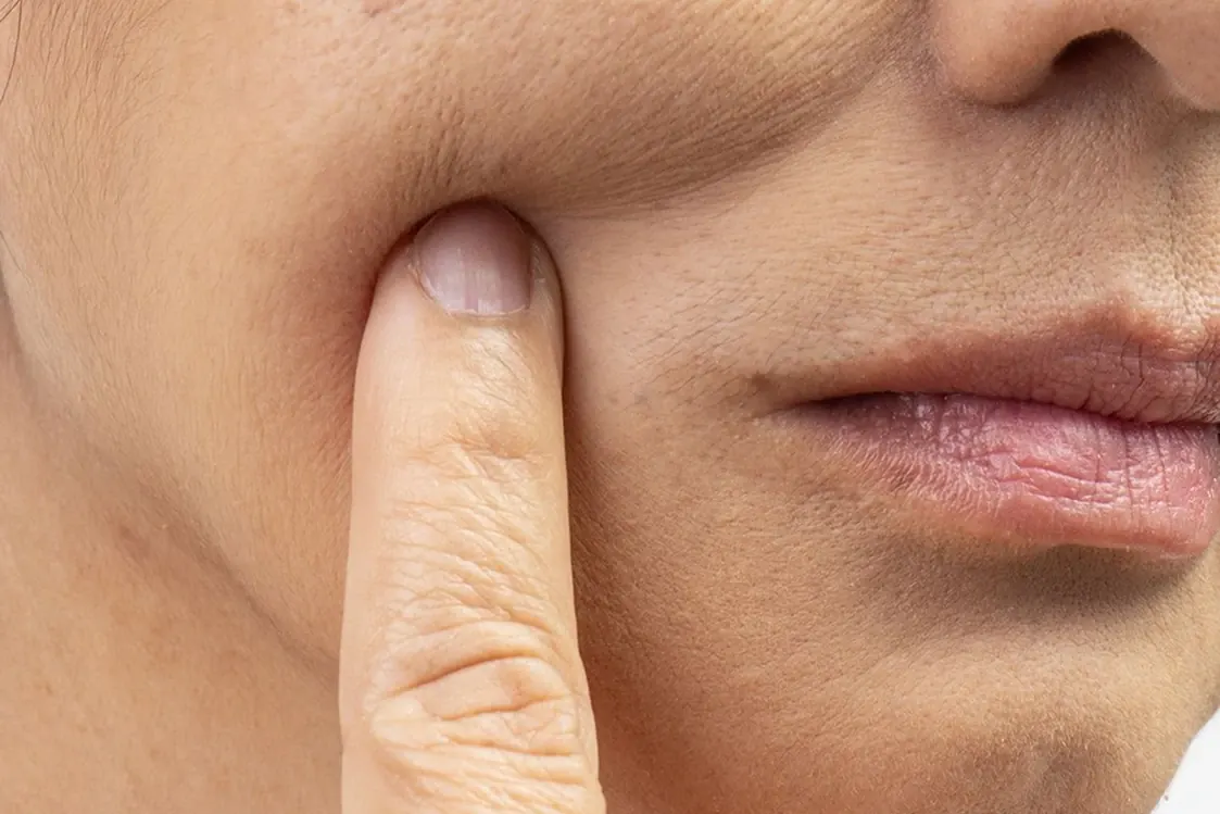 Arrugas finas tratadas con peeling Cleopatra en Alef Med Valencia