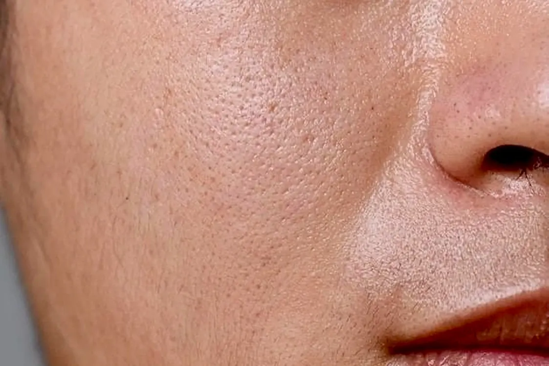 Piel grasa y poros dilatados tratados con peeling Cleopatra en Alef Med Valencia