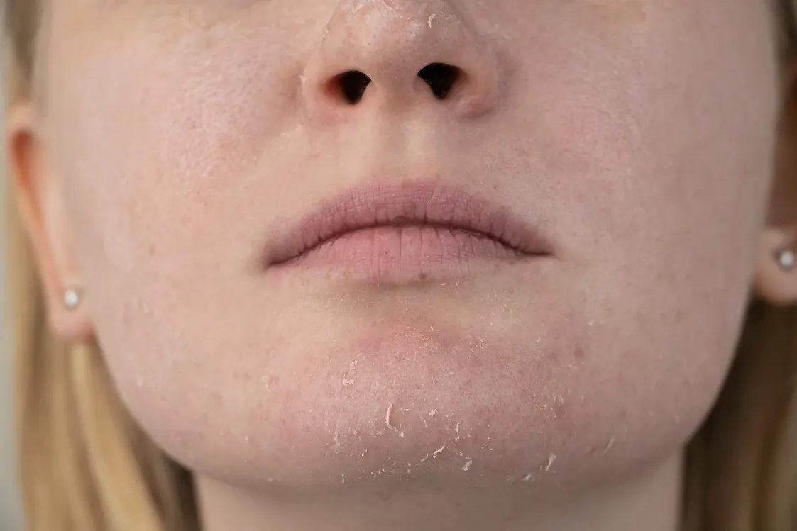 Piel apagada evaluada en diagnóstico facial Skin PRO en Alef Med Valencia