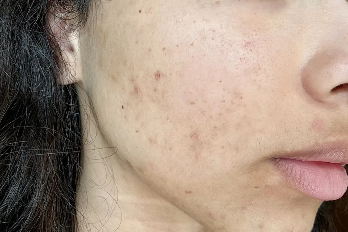 Non-active acne treated with facial cleansing at Alef Med Valencia