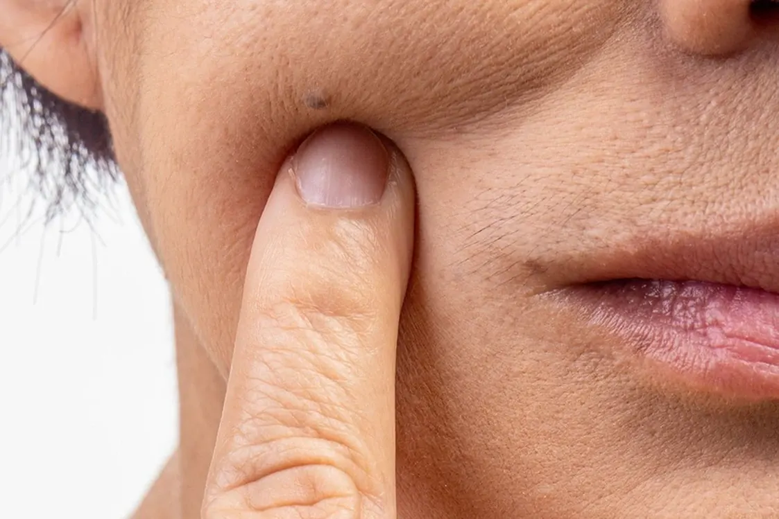 Piel apagada tratada con peeling profesional en Alef Med Valencia