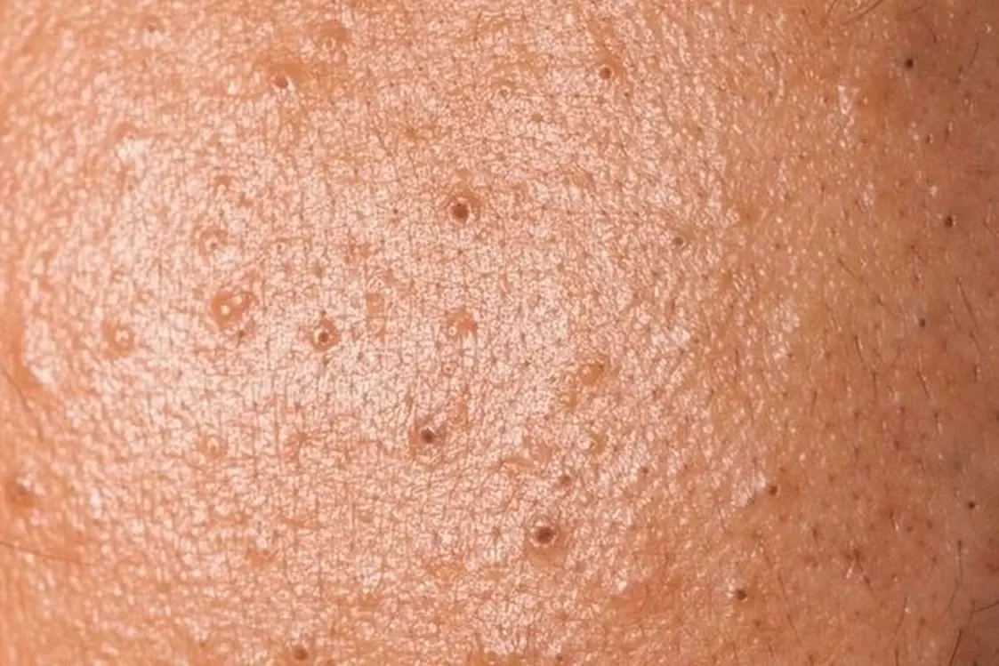 Очищение закупоренных пор с помощью Hydropeeling в клинике Alef Med Valencia
