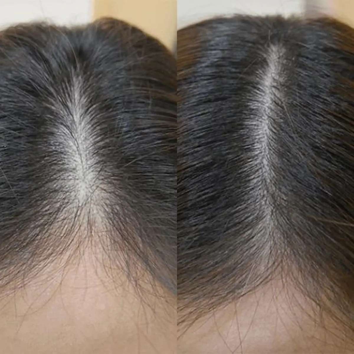 Resultado antes y después de Hair Booster, caso 5, en Alef Med Valencia