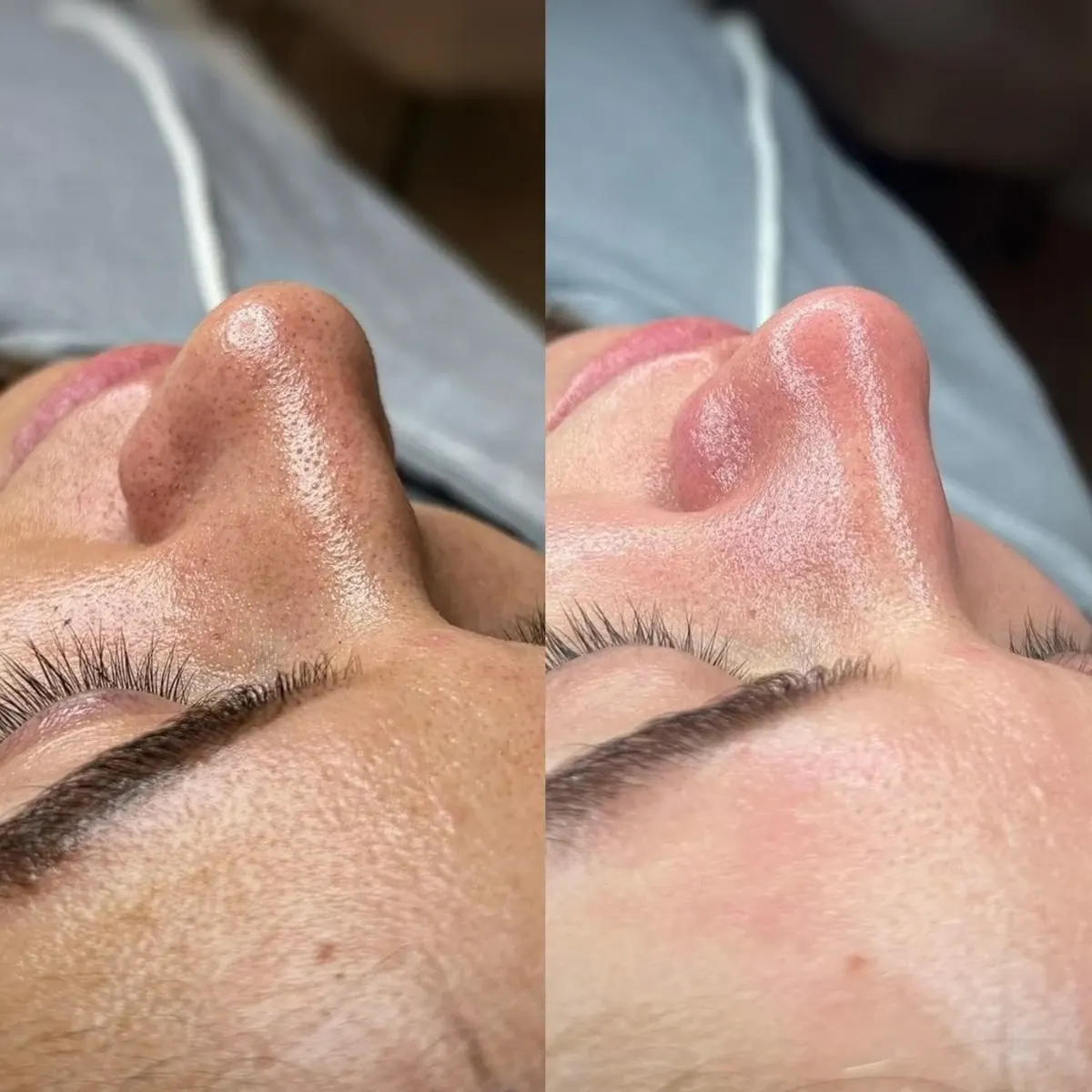Before and after result of Hydropeeling, case 2, at Alef Med Valencia
