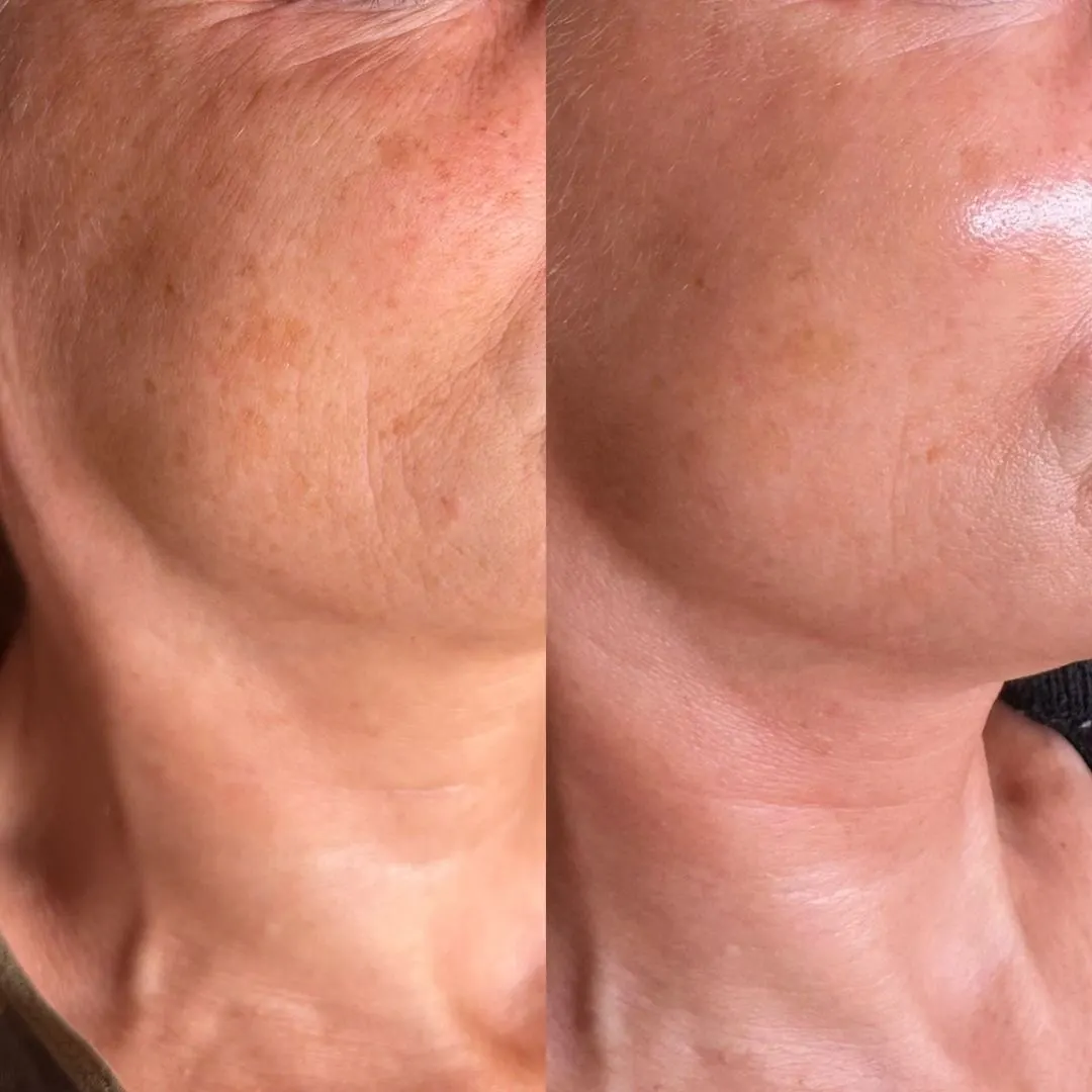 Resultado antes y después del peeling Derma Glow, caso 5, en Alef Med Valencia