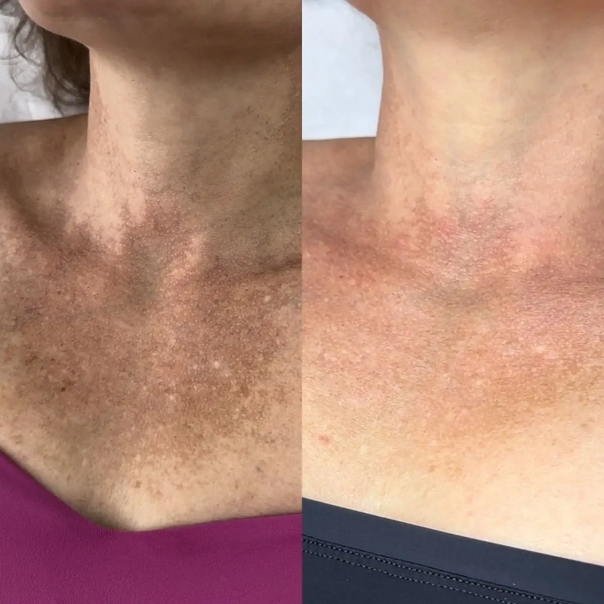 Resultado antes y después de fototerapia IPL, caso 5, en Alef Med Valencia