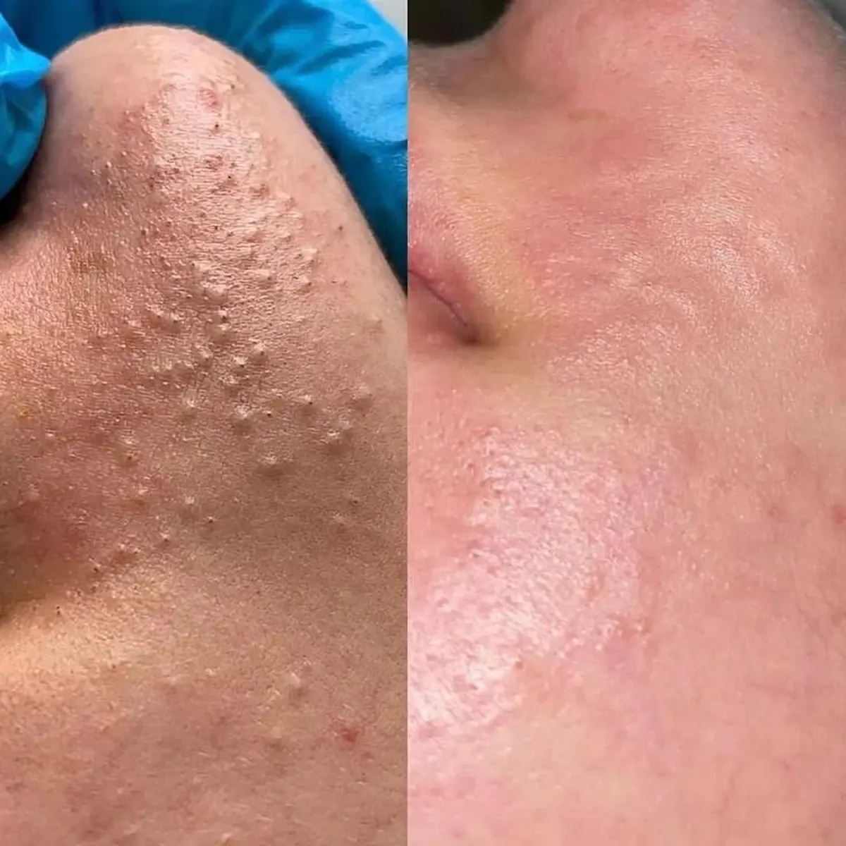 Resultado antes y después de limpieza facial combinada, caso 3, en Alef Med Valencia