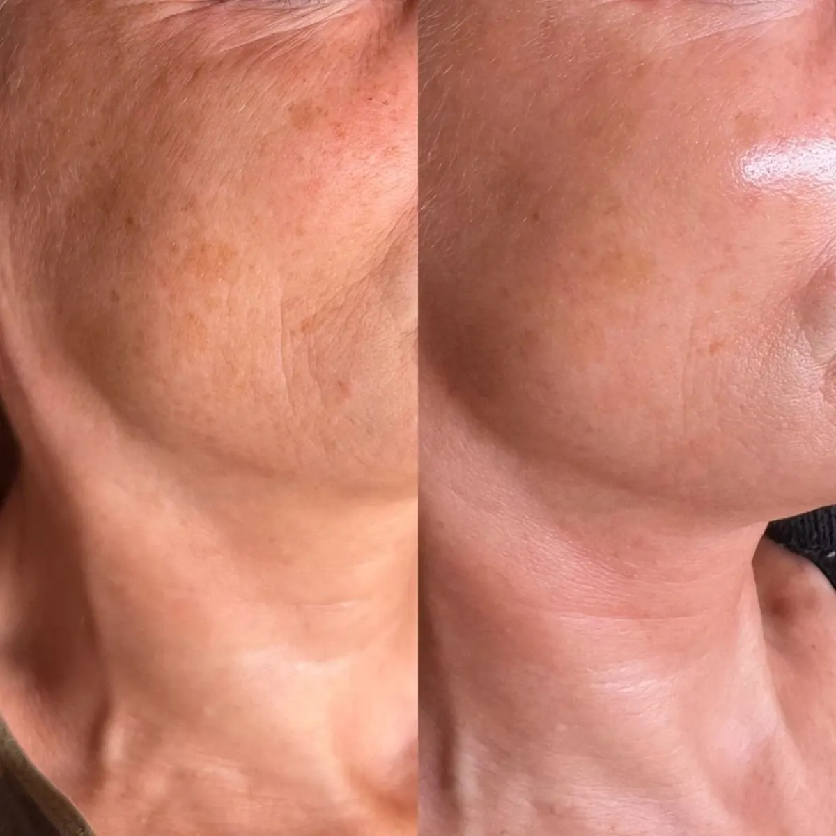 Resultado antes y después de Glow Sin Manchas, caso 3, en Alef Med Valencia