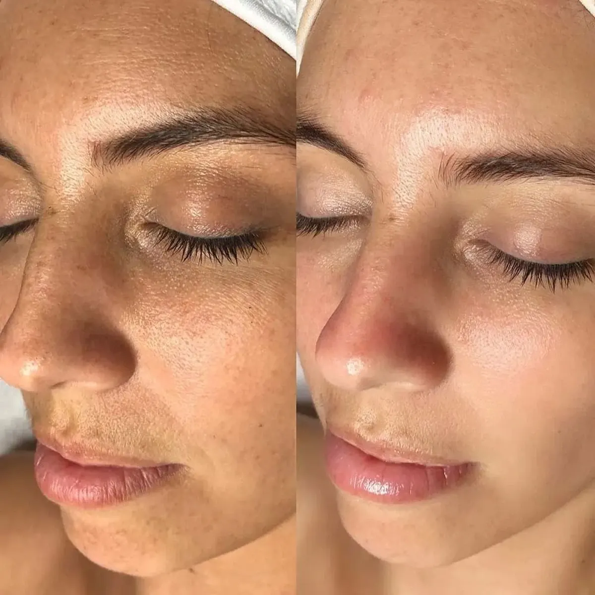 Resultado antes y después de Glow Sin Manchas, caso 1, en Alef Med Valencia