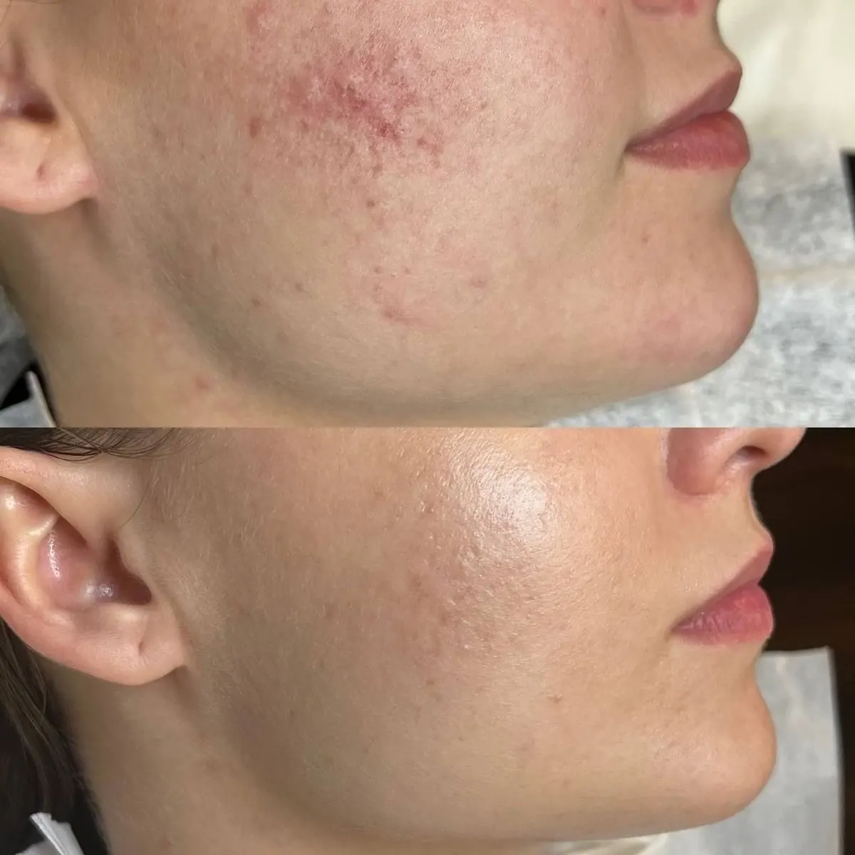 Before and after result of IPL phototherapy, case 1, at Alef Med Valencia