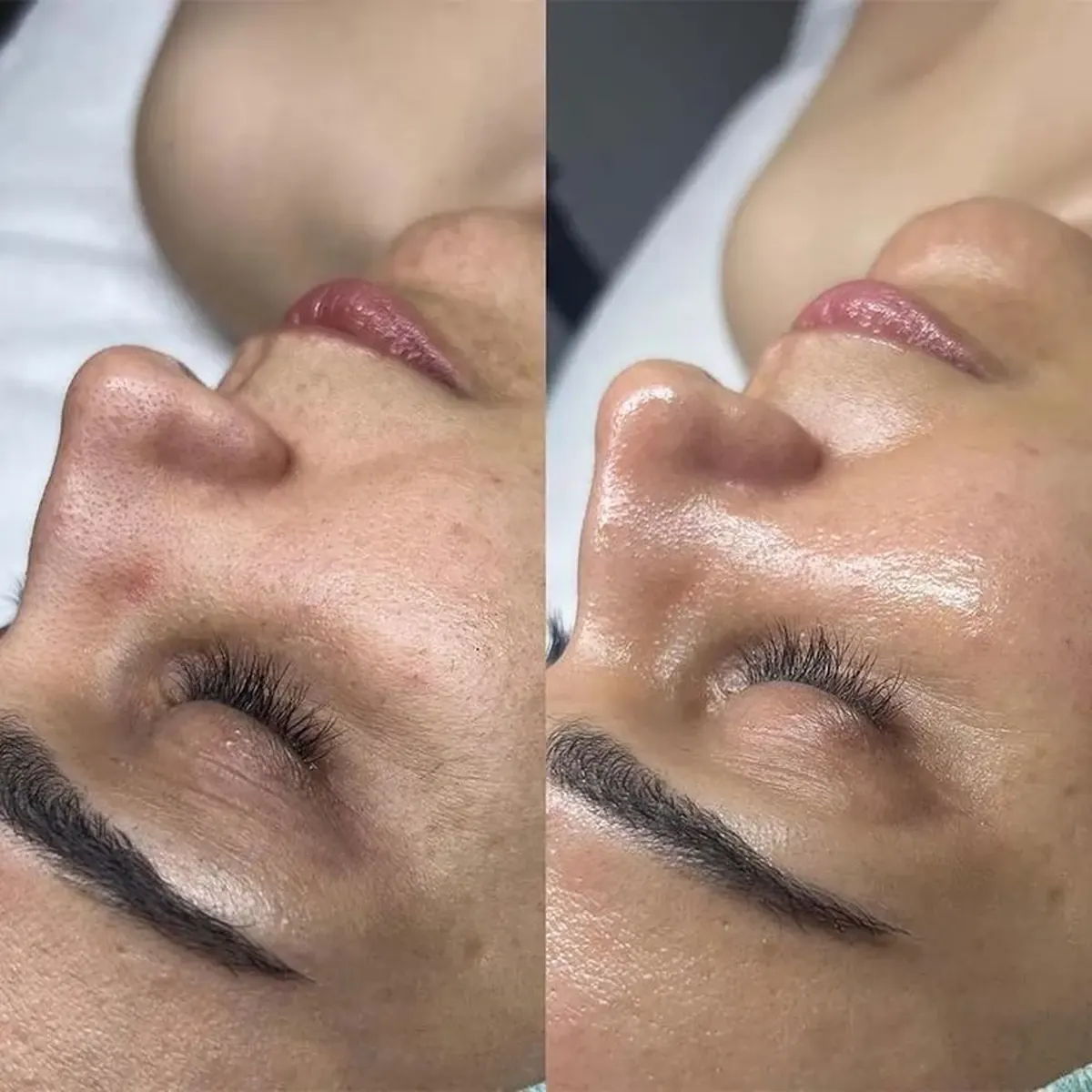 Before and after result of Hydropeeling, case 1, at Alef Med Valencia