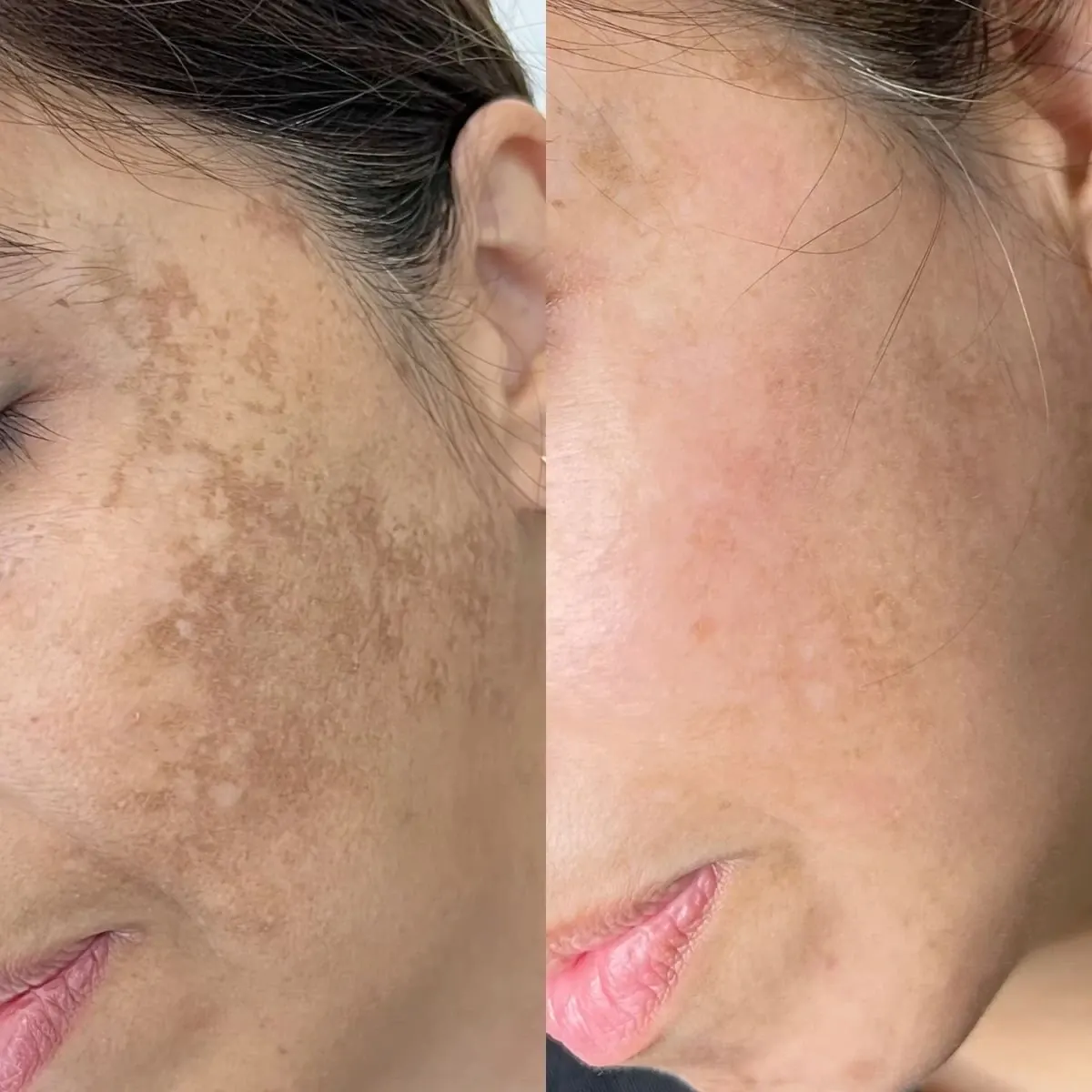 Before and after result of IPL phototherapy, case 4, at Alef Med Valencia