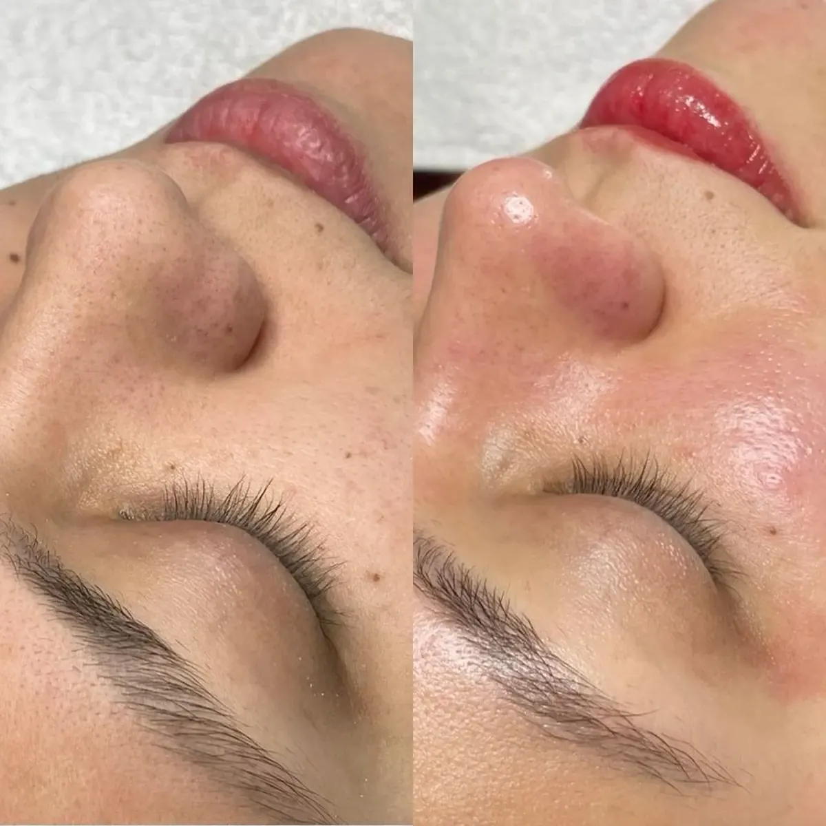 Before and after result of Hydropeeling, case 4, at Alef Med Valencia