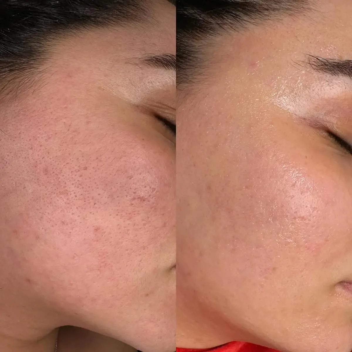 Before and after result of Microneedling, case 5, at Alef Med Valencia