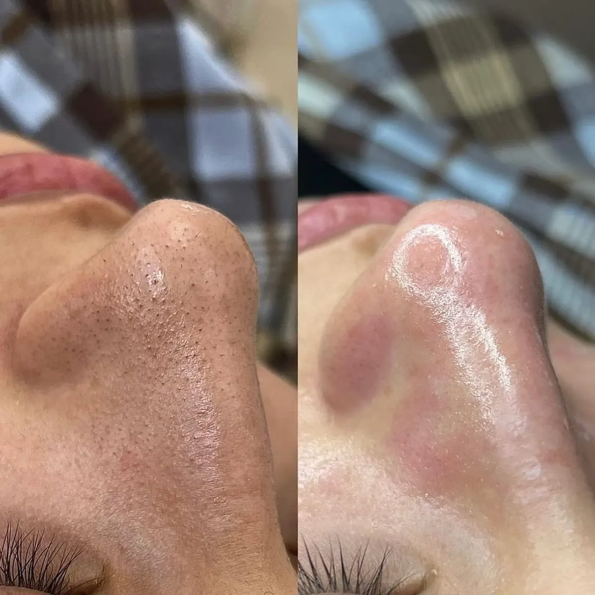 Before and after result of Hydropeeling, case 3, at Alef Med Valencia