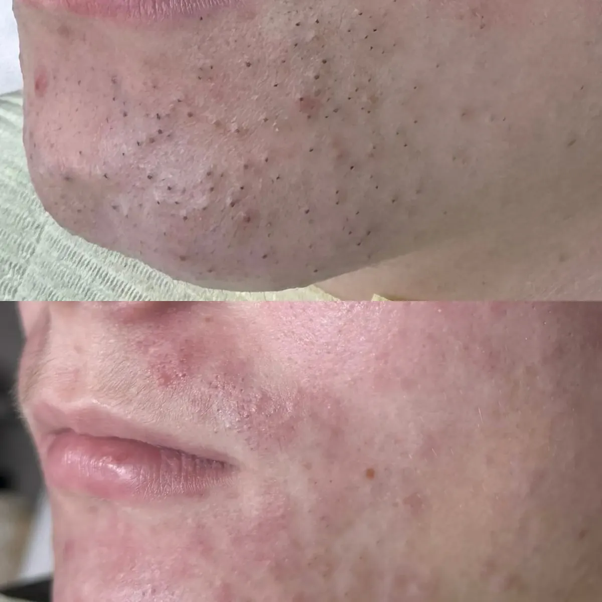 Resultado antes y después de limpieza facial combinada, caso 5, en Alef Med Valencia