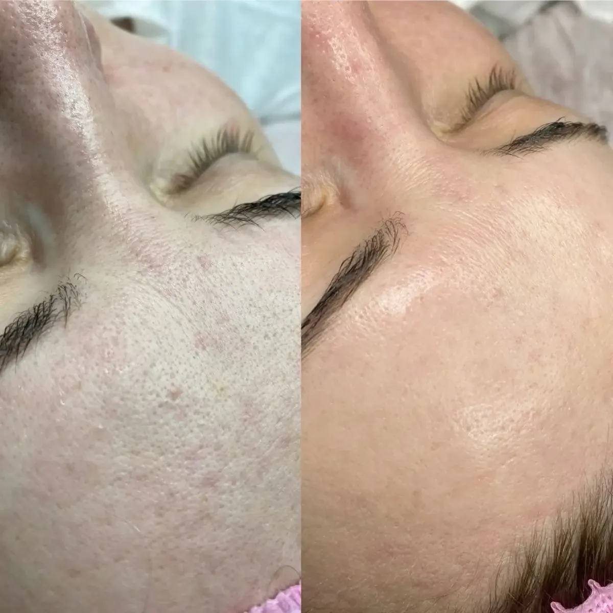 Resultado antes y después del peeling de carbón, caso 3, en Alef Med Valencia