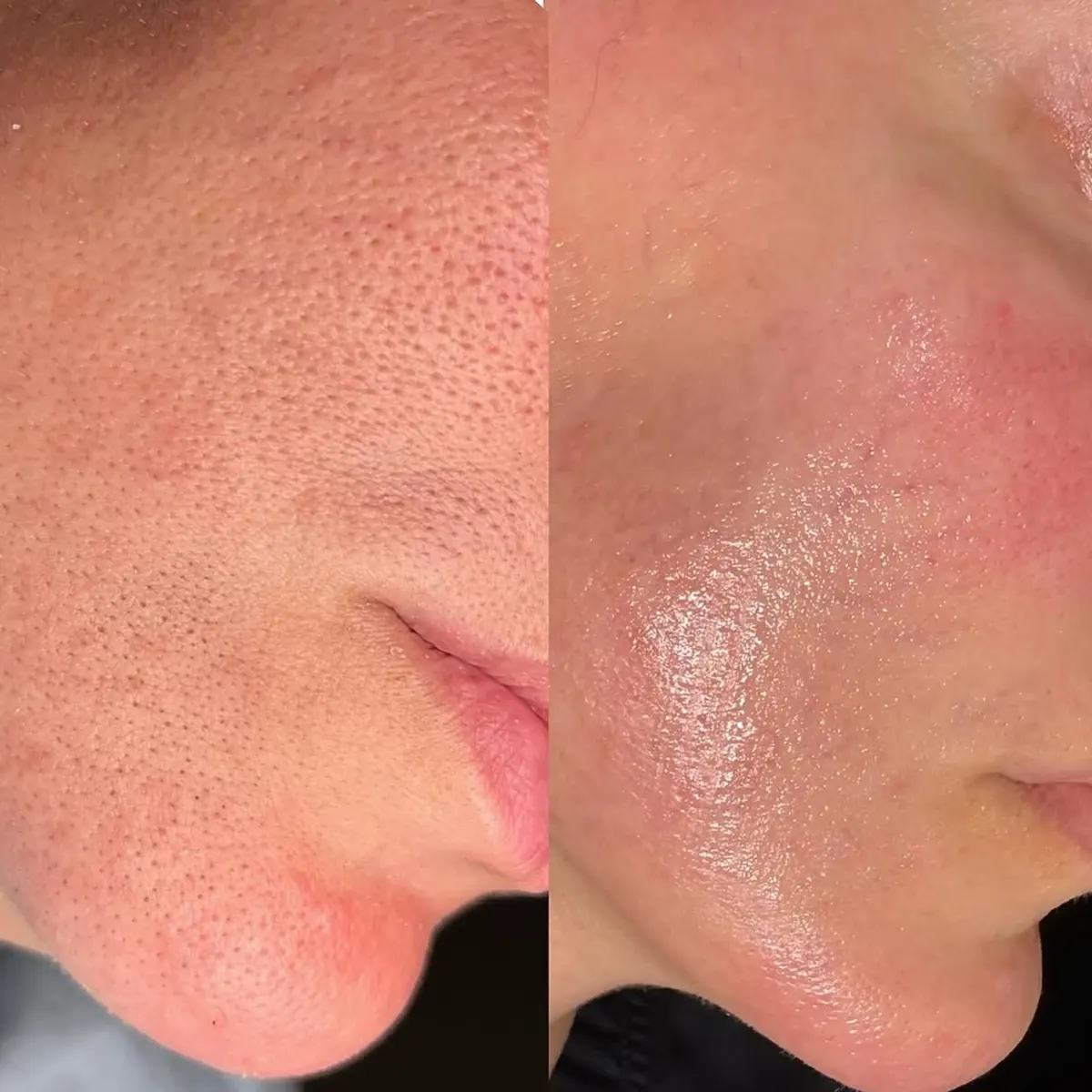 Resultado antes y después de Microneedling, caso 1, en Alef Med Valencia