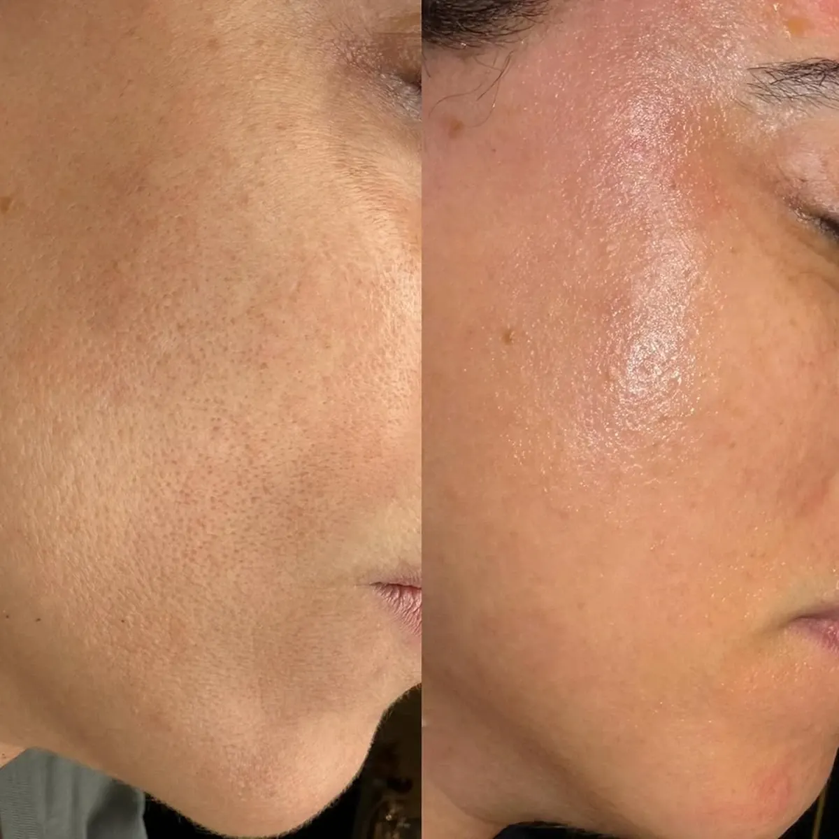 Resultado antes y después del peeling Hikari Cleopatra, caso 4, en Alef Med Valencia