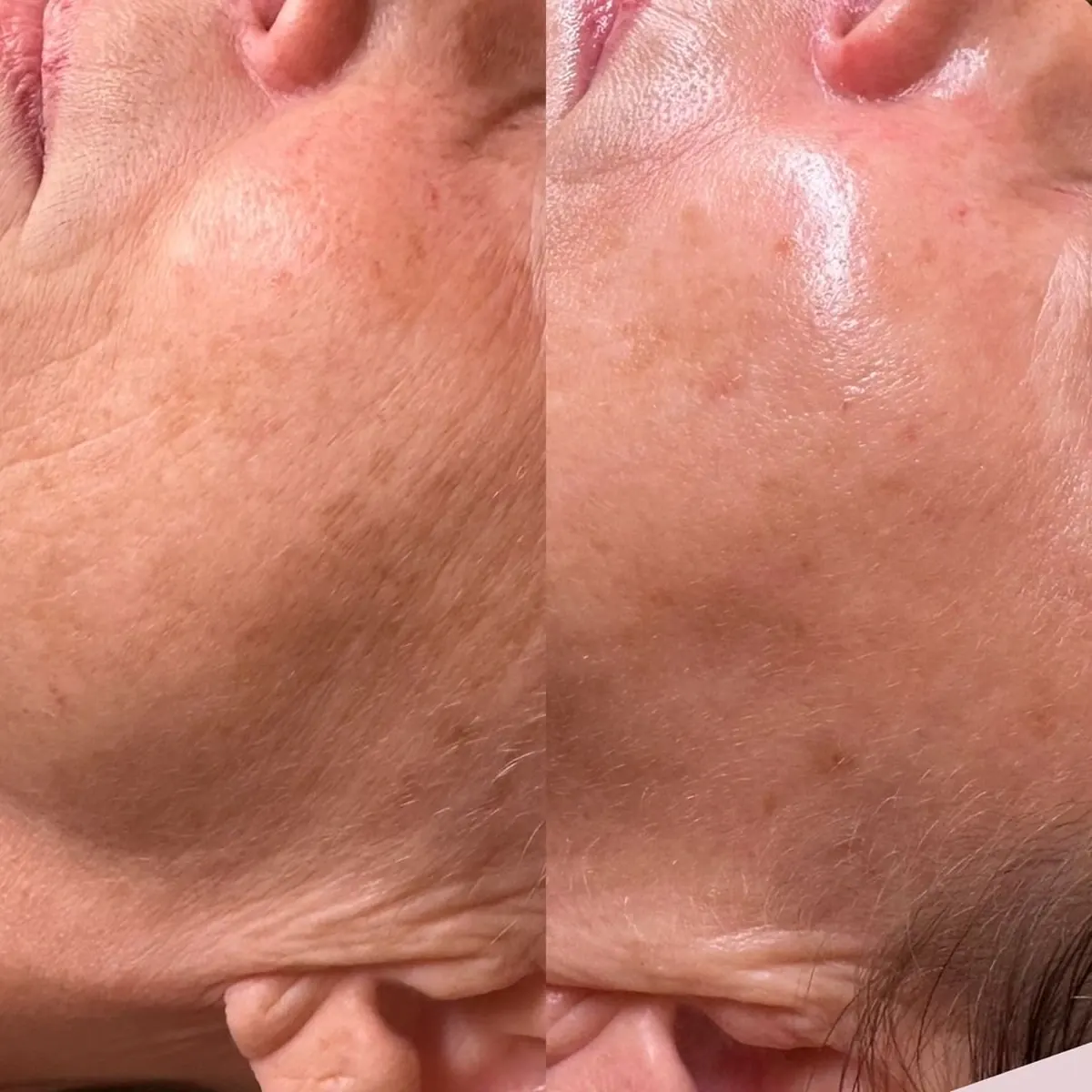 Before and after result of RF Lifting, case 5, at Alef Med Valencia