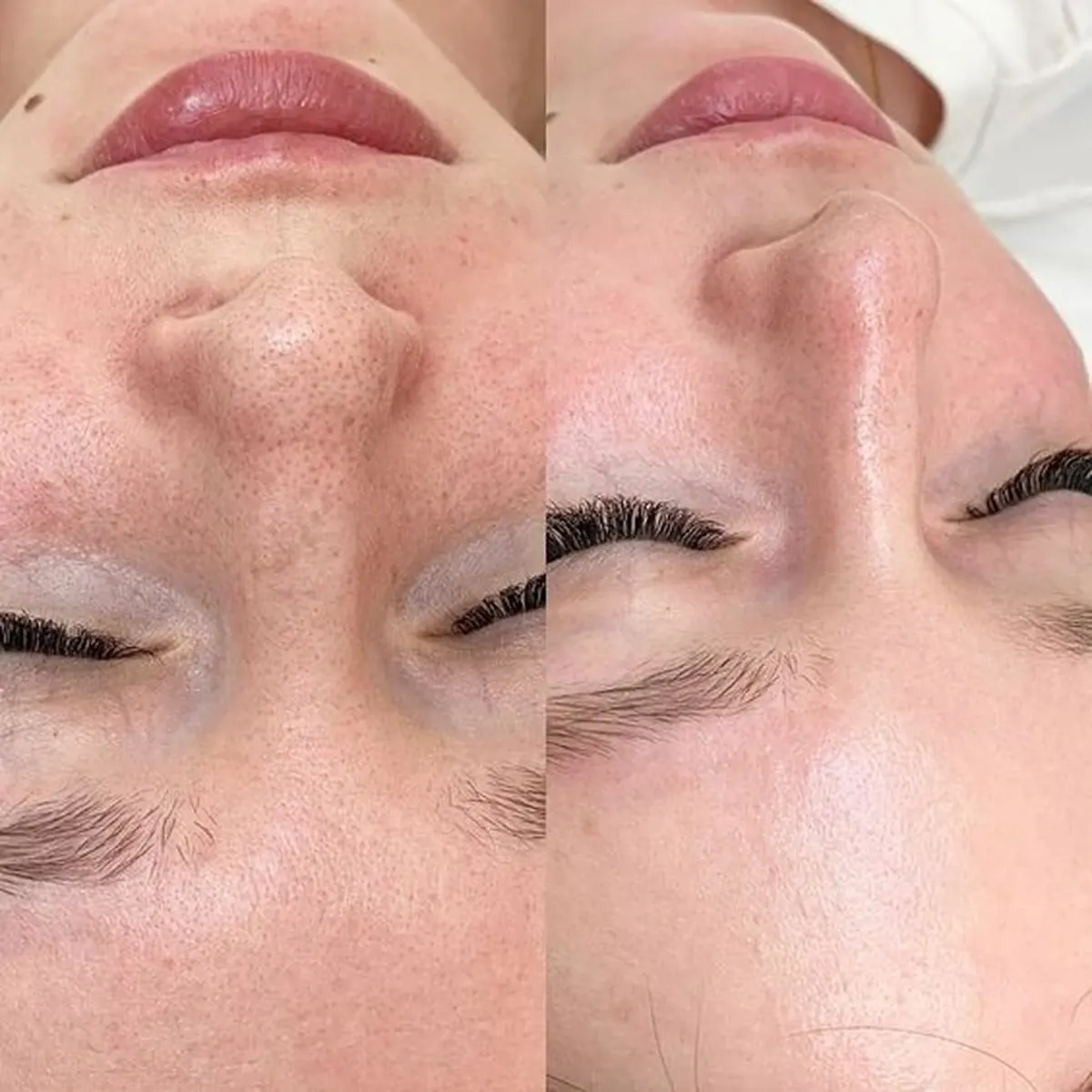 Before and after result of Hydropeeling, case 5, at Alef Med Valencia