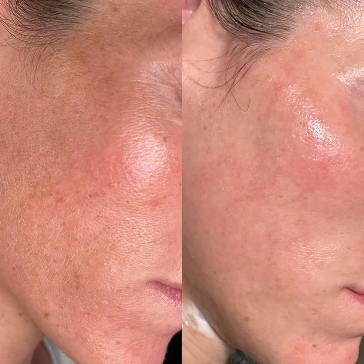 Resultado antes y después de Microneedling, caso 4, en Alef Med Valencia