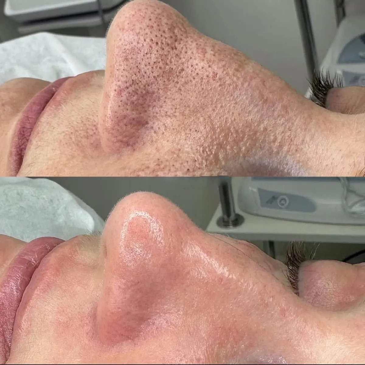 Resultado antes y después de limpieza facial combinada, caso 1, en Alef Med Valencia