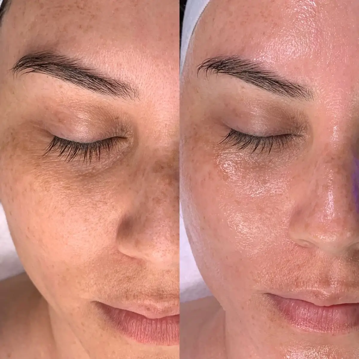 Resultado antes y después de Glow Sin Manchas, caso 2, en Alef Med Valencia