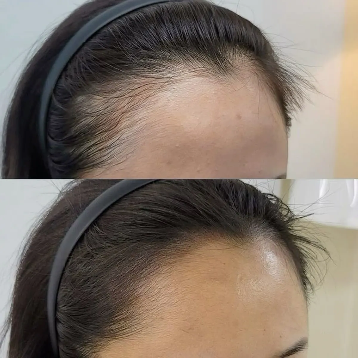 Resultado antes y después de Hair Booster, caso 3, en Alef Med Valencia
