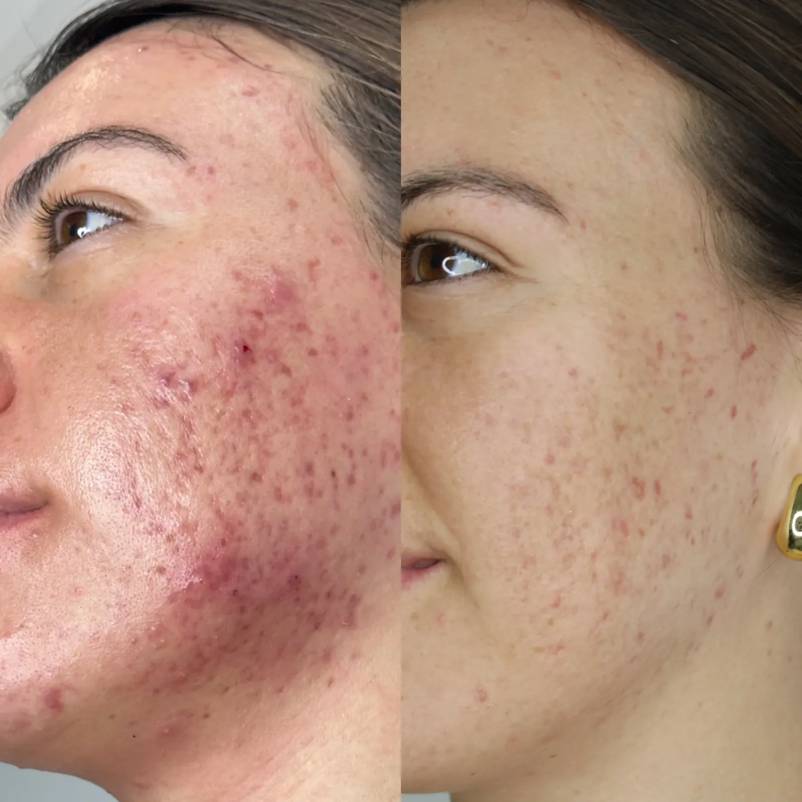 Resultado antes y después del peeling Derma Glow, caso 1, en Alef Med Valencia