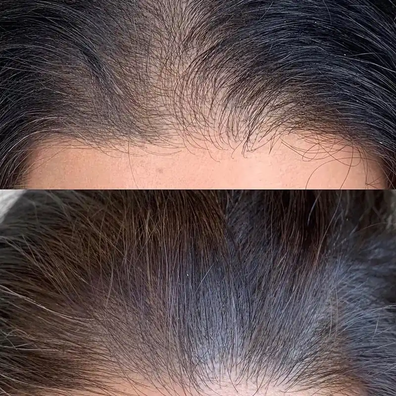 Resultado antes y después de Hair Booster, caso 2, en Alef Med Valencia
