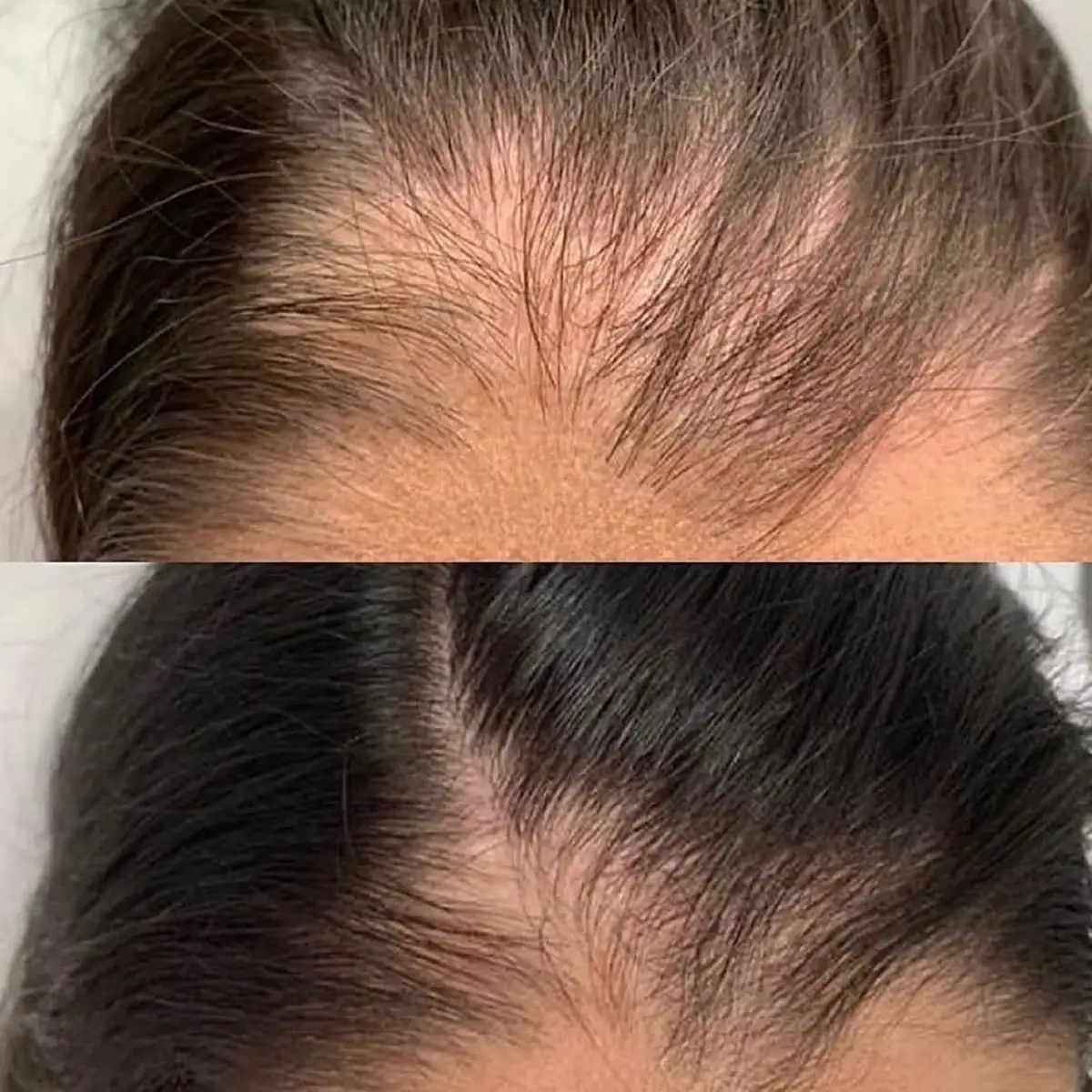Resultado antes y después de Hair Booster, caso 1, en Alef Med Valencia