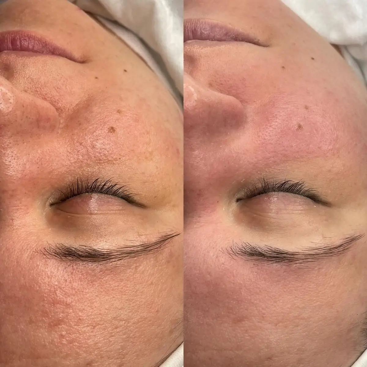 Resultado antes y después de Glow Sin Manchas, caso 5, en Alef Med Valencia