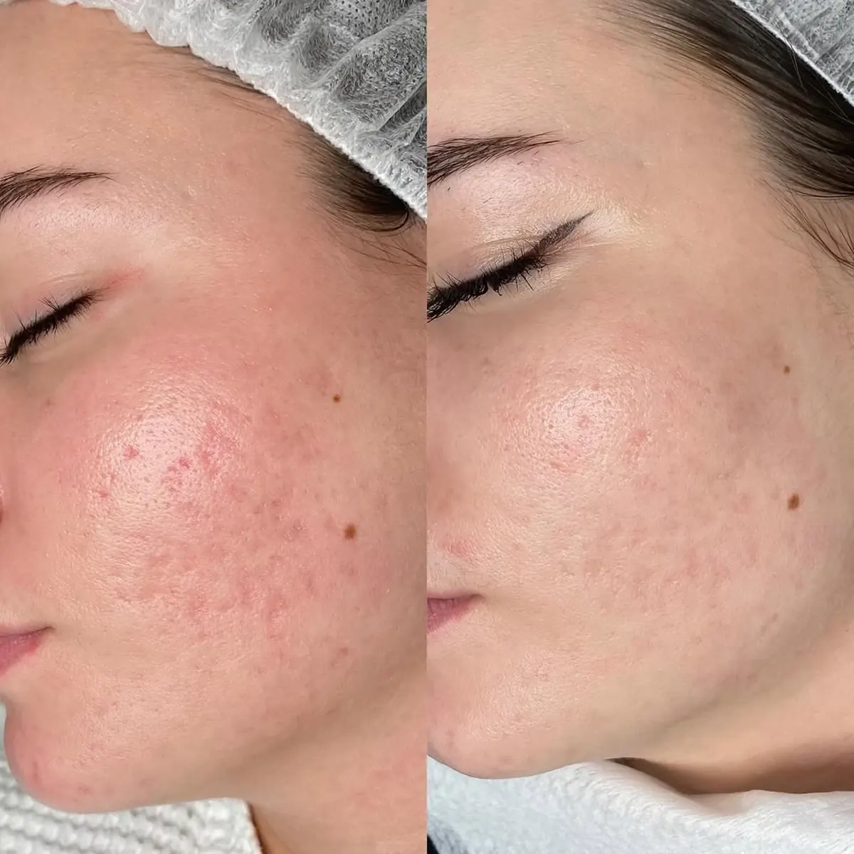 Resultado antes y después de fototerapia IPL, caso 3, en Alef Med Valencia