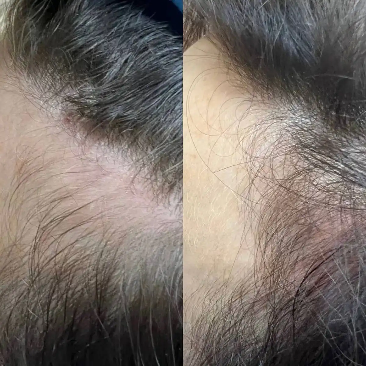 Resultado antes y después de Hair Booster, caso 4, en Alef Med Valencia