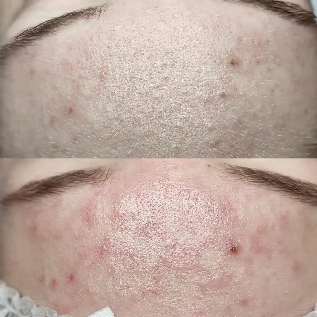 Resultado antes y después de limpieza facial combinada, caso 4, en Alef Med Valencia