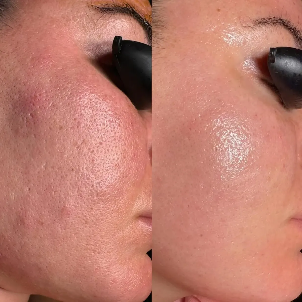 Resultado antes y después del peeling Hikari Cleopatra, caso 3, en Alef Med Valencia