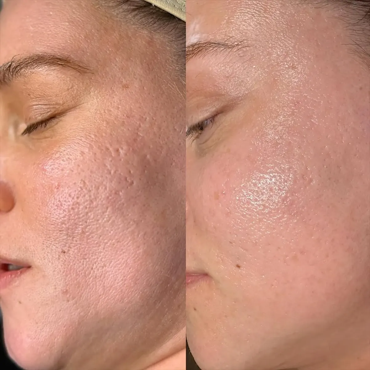 Before and after result of Hikari Cleopatra peel, case 2, at Alef Med Valencia