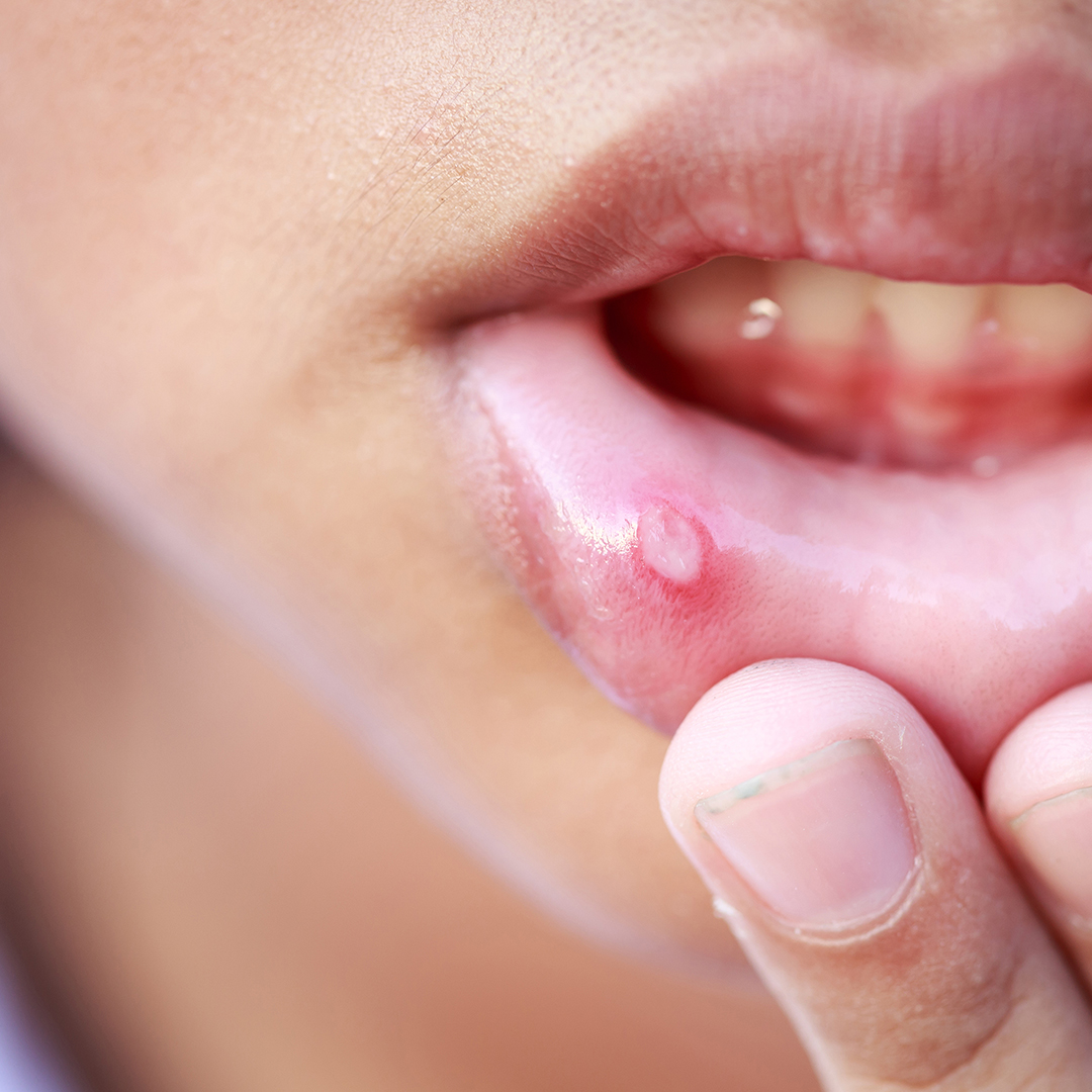 aftas bucales