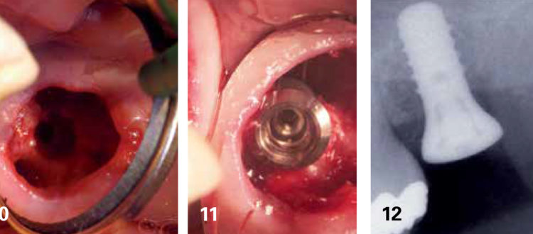 Implantation immédiate d’un site de molaire méthode et astuce