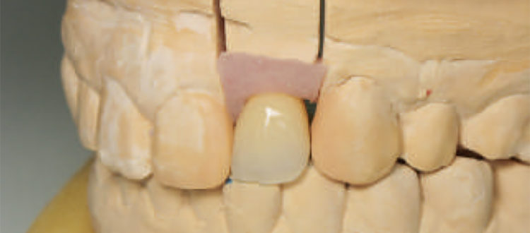 Implantologie esthetique et cadcam
