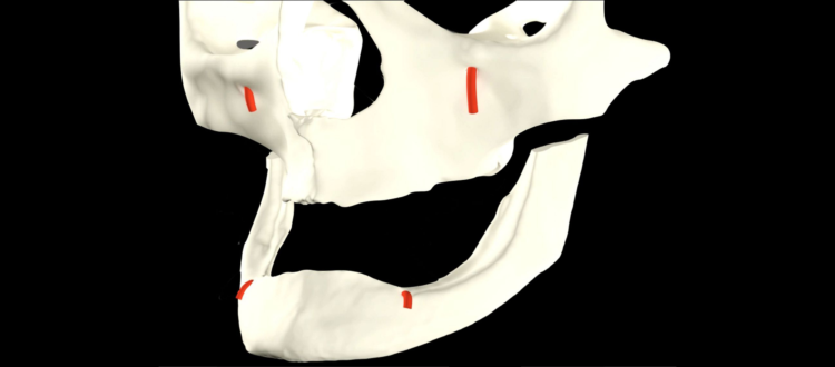 Bimaxillary full edentulous graft-less rehabilitation with straumann® zygomatic implants and straumann® mini-implants