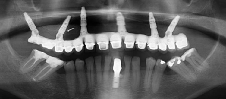Maxillaire atrophié : de la mise en charge immédiate sur implants angulés à la restauration finale