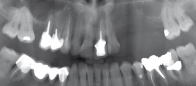 Les greffes osseuses sur mesure : technologie maxgraft® bonebuilder