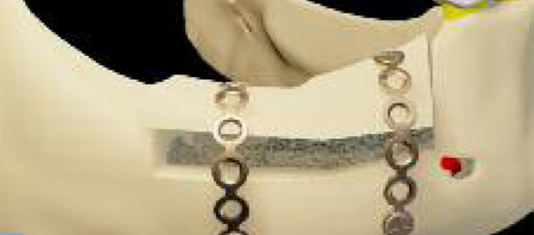 Ostéotomie de rotation pour une augmentation horizontale à la mandibule