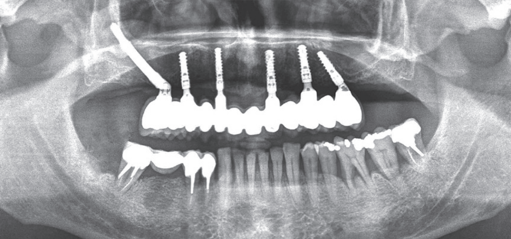 New zygomatic implant design : adapting to the anatomy