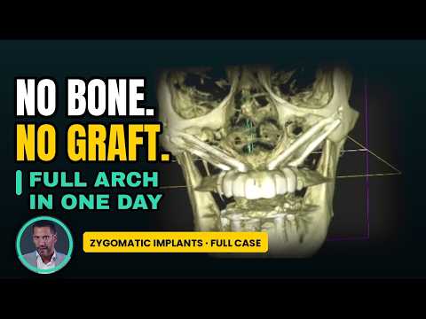 Failed Implants Fixed in ONE DAY | Zygomatic Case by Dr. Sepehr Zarrine