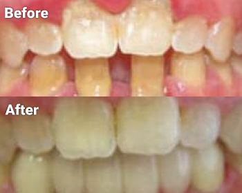 Before & After image