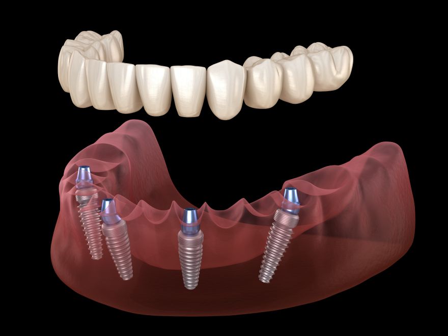 snap in dentures